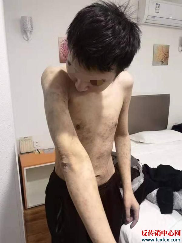 22歲小伙誤入香河傳銷 被解救時精神遲鈍渾身疥瘡